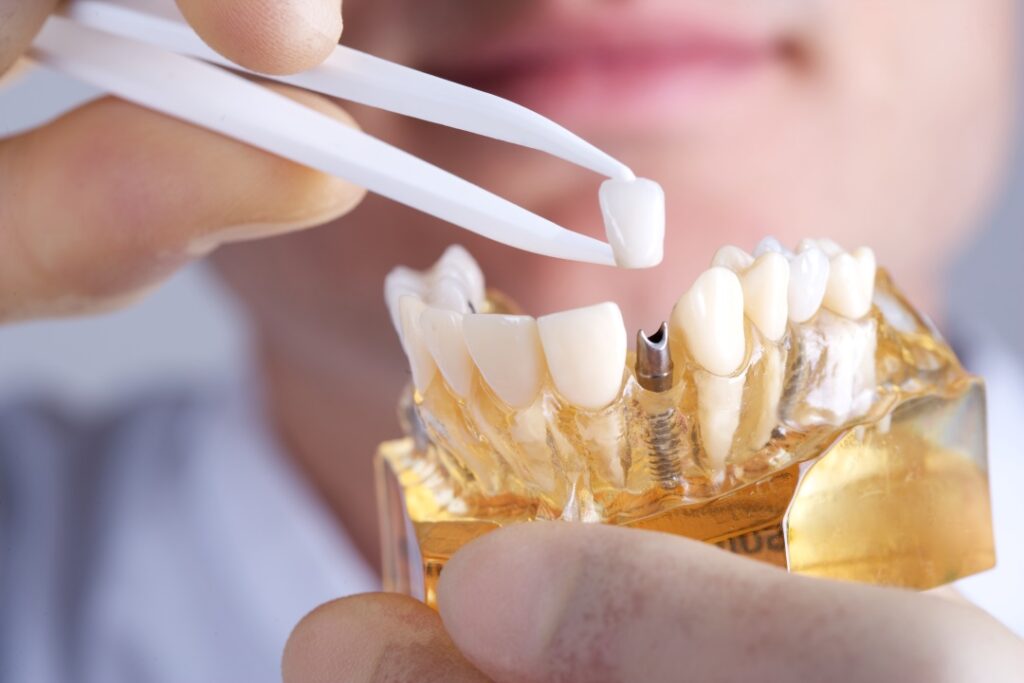 dental implants in etobicoke