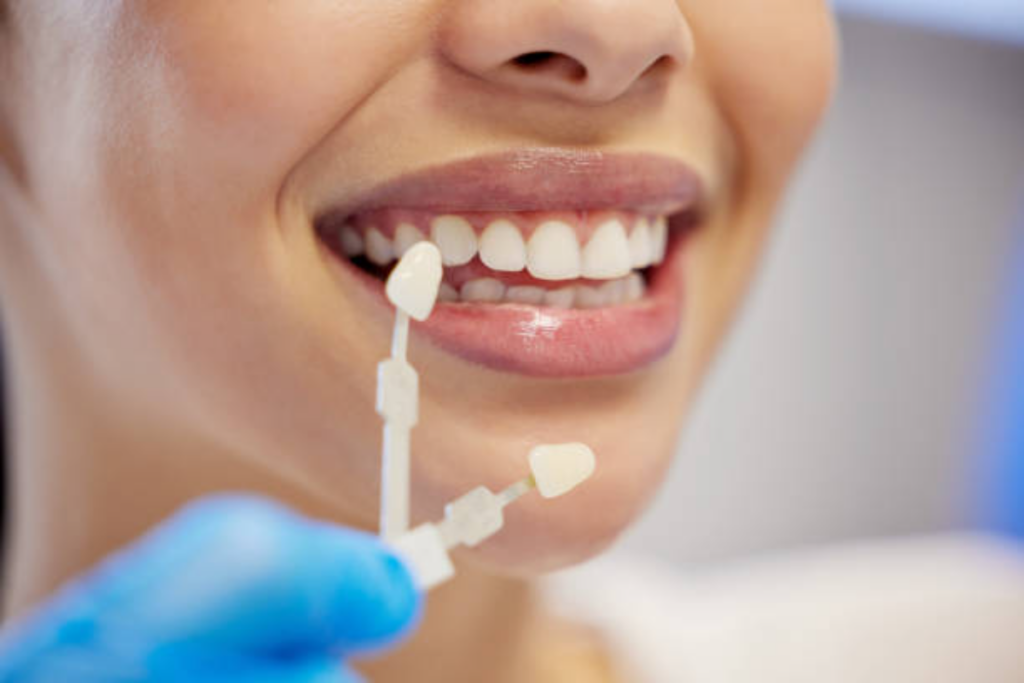 tips to maintain dental veneers for long lasting effect